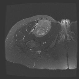 Leimyosarcoma Femoral Vein MRI Axial T2